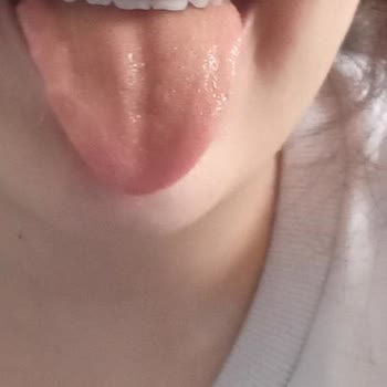 Ülker Pastil İle Dil Boğaz Ve Midede Yanma Hissi