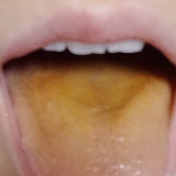 Ülker Pastil İle Dil Boğaz Ve Midede Yanma Hissi