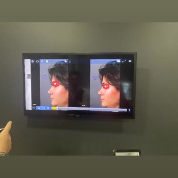 Özel 7M Hastanesi Burun Ameliyatı Mağduriyeti