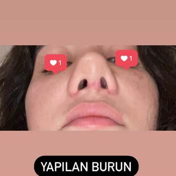 Özel 7M Hastanesi Burun Ameliyatı Mağduriyeti