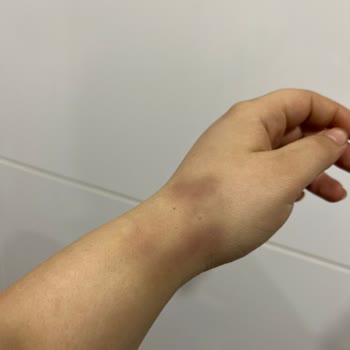 Özel Batıkent Hastanesi Damar Yolu Açmasını Bile Beceremeyen Hemşire