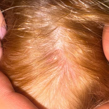 Palette Saç Boyasından Saç Derim Yandı