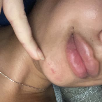 Felix Bakırköy Clinic Dudak Dolgusu Şikayeti