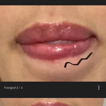 Uzm. Dr. Miray Tümer Güzellik Salonunda Yaşanan Dolgu Problemi Hakkında