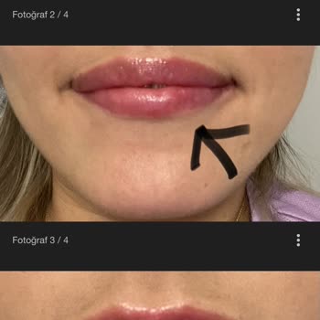 Uzm. Dr. Miray Tümer Güzellik Salonunda Yaşanan Dolgu Problemi Hakkında