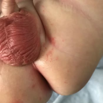 Molfix Bez 4 Numara Aşırı Pişik Yaptı