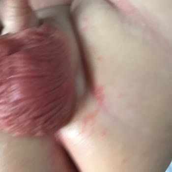 Molfix Bez 4 Numara Aşırı Pişik Yaptı