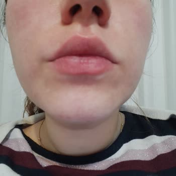 Neutrogena Peeling Yüzümü Yaktı