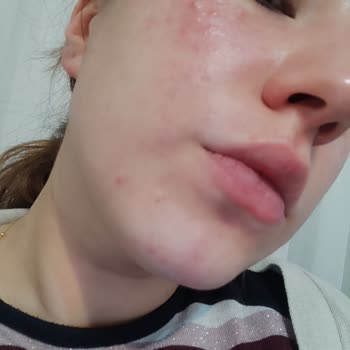 Neutrogena Peeling Yüzümü Yaktı