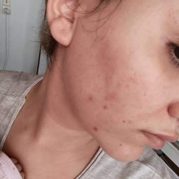 The Purest Solutions Purest Ürünleri Şikayeti