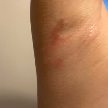 Yves Rocher Roll-On Kullanımı Sonrası Ciltte Alerjik Reaksiyon Şikayeti