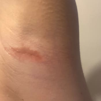 Yves Rocher Roll-On Kullanımı Sonrası Ciltte Alerjik Reaksiyon Şikayeti