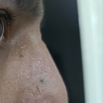 Dr. İbrahim Akın Burun Estetiği Mağduriyeti!