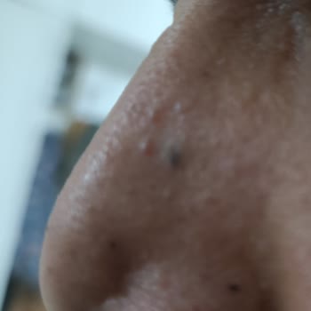 Dr. İbrahim Akın Burun Estetiği Mağduriyeti!