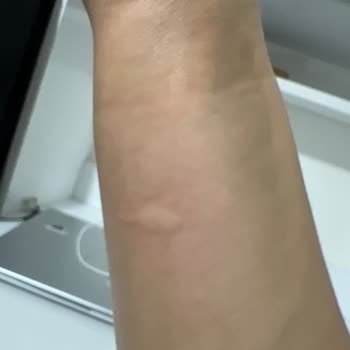 Duracell Pil Aktığı İçin Kolumda Yandı