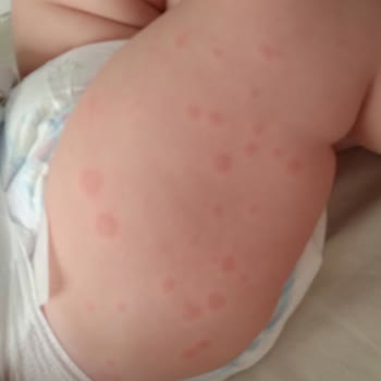 Bebelac Alerji Yapıyor Acil Çözüm