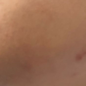 Bioderma Cilt Bakımında Beklenmedik Komedon Sorunu