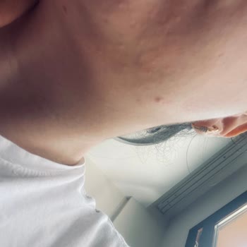 Bioderma Cilt Bakımında Beklenmedik Komedon Sorunu