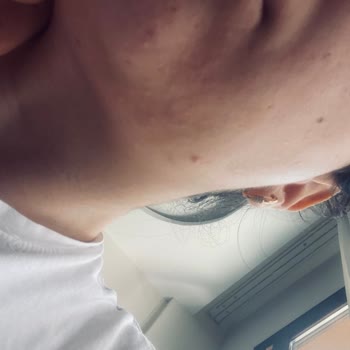 Bioderma Cilt Bakımında Beklenmedik Komedon Sorunu