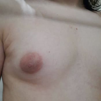 Op. Dr. Murat Uçak Estetik Klinik Hatalı Jinekomasti Ameliyatı!
