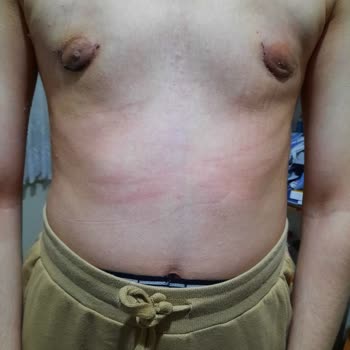 Op. Dr. Murat Uçak Estetik Klinik Hatalı Jinekomasti Ameliyatı!