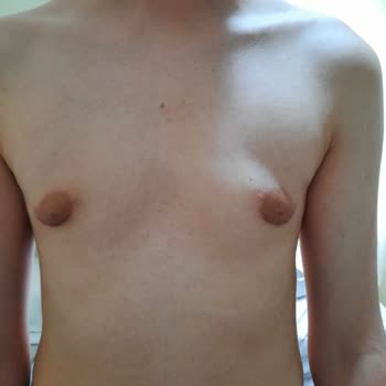 Op. Dr. Murat Uçak Estetik Klinik Hatalı Jinekomasti Ameliyatı!