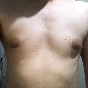 Op. Dr. Murat Uçak Estetik Klinik Hatalı Jinekomasti Ameliyatı!