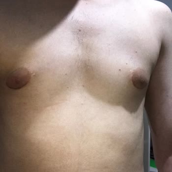 Op. Dr. Murat Uçak Estetik Klinik Hatalı Jinekomasti Ameliyatı!