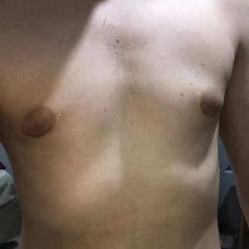 Op. Dr. Murat Uçak Estetik Klinik Hatalı Jinekomasti Ameliyatı!