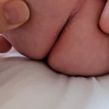 Mustela Pişik Kremi Sivilce Yaptı