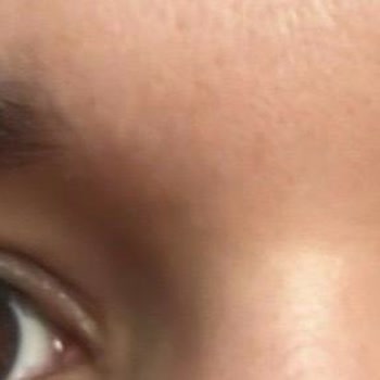 Yasemin Bedir Beauty & Esthetic Botoks Sonrası Göz Kapağı Gözü Kapatacak Kadar Düştü