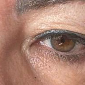 Yasemin Bedir Beauty & Esthetic Botoks Sonrası Göz Kapağı Gözü Kapatacak Kadar Düştü