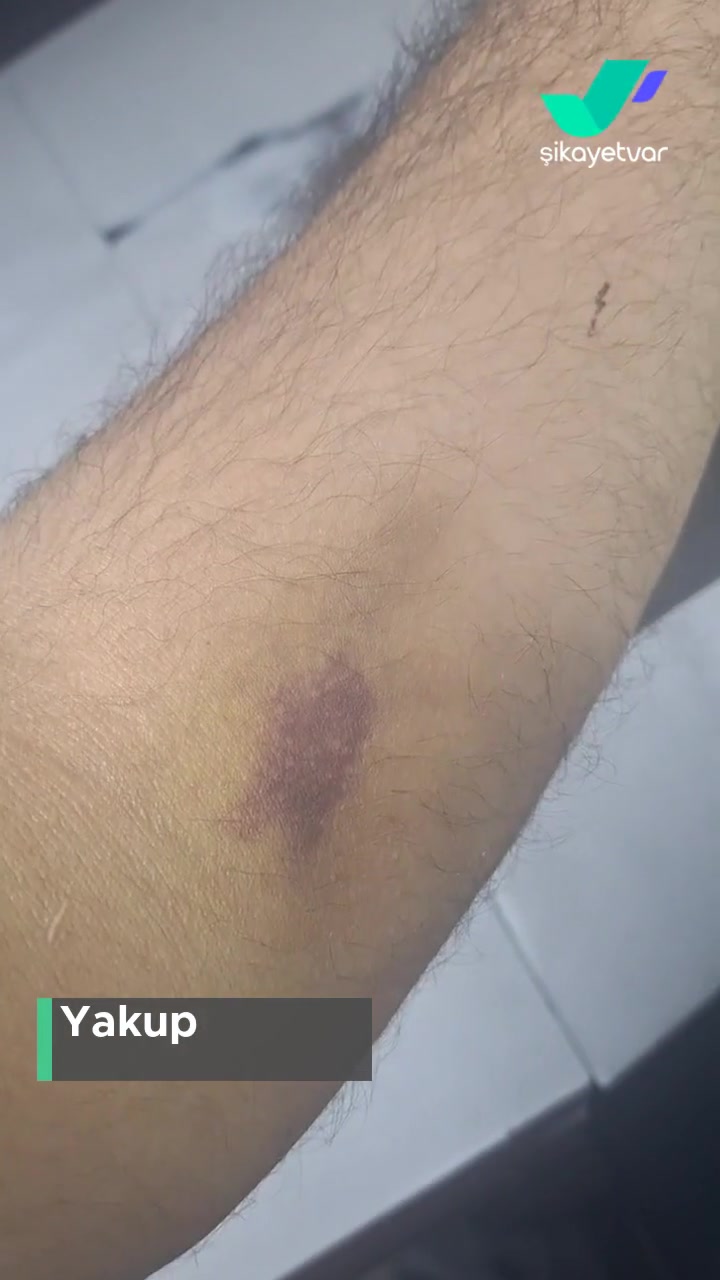 Başakşehir Çam Ve Sakura Şehir Hastanesi Ağrı Kesici Sonrası Parmağım Şişti! videonun kapak resmi