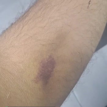 Başakşehir Çam Ve Sakura Şehir Hastanesi Ağrı Kesici Sonrası Parmağım Şişti!