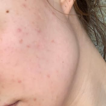 Maruderm Maruz-derm Serum Yüzünden Yüzümü Sivilce Bastı!