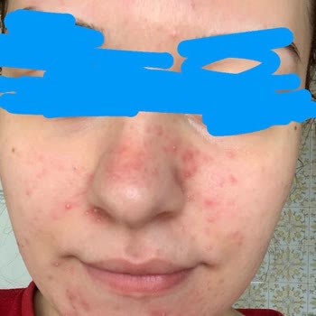 Maruderm Maruz-derm Serum Yüzünden Yüzümü Sivilce Bastı!