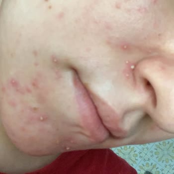 Maruderm Maruz-derm Serum Yüzünden Yüzümü Sivilce Bastı!