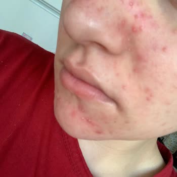 Maruderm Maruz-derm Serum Yüzünden Yüzümü Sivilce Bastı!