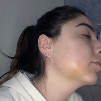 Beşiktaş Dentistanbul Gömülü Diş Çekimi