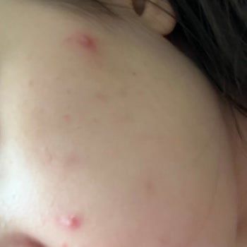 Mia Klinika Güneş Kremi Cildimi Mahvetti