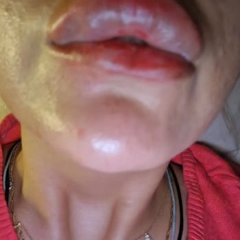 Demet Buket Güzellik & Estetik Dudak Dolgusu Felaketi