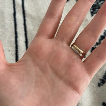 Starbucks'ta Dezenfektandan Kaynaklanan Kimyasal Yanık