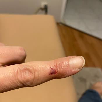 Özel Medar Hastaneleri Küçük Yaralanma İçin Büyük Fatura