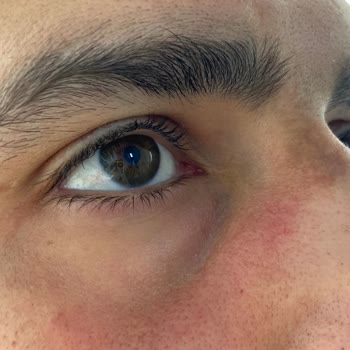 Yves Rocher Yüz Kızarması Ve Yakıyor Olması Ürünün