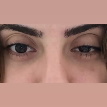 Clinic Ataşehir Botokstan Dolayı Göz Kapağım Düştü