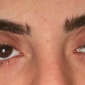 Clinic Ataşehir Botokstan Dolayı Göz Kapağım Düştü