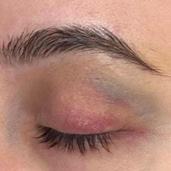 Medica Derma Pendik Botoks Mağduriyeti