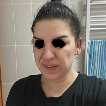 Op. Dr. Ekrem Keskin Yüzümün Şeklini Bozdu