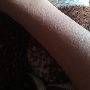 Agiss Markası Alerji Yaptı