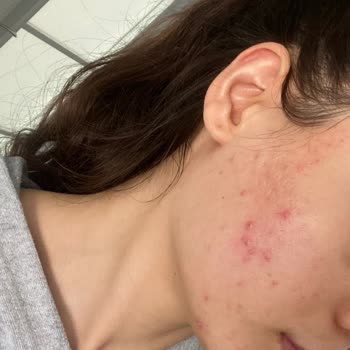 Caudalie Yüzümde Sivilceler Çıktı